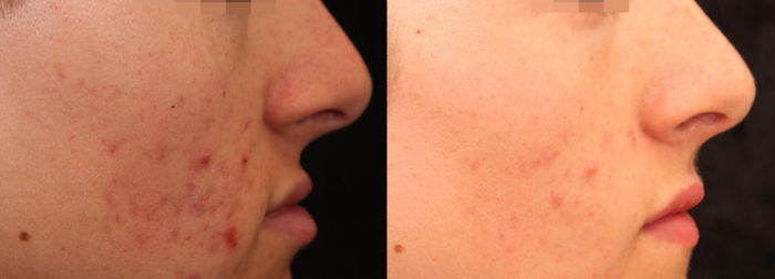 Active acne laser treatment