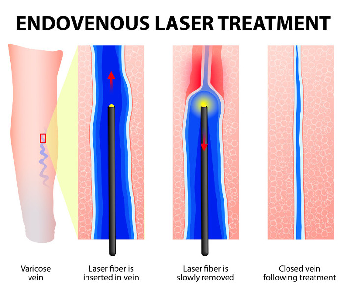 traitement au laser endoveineux 