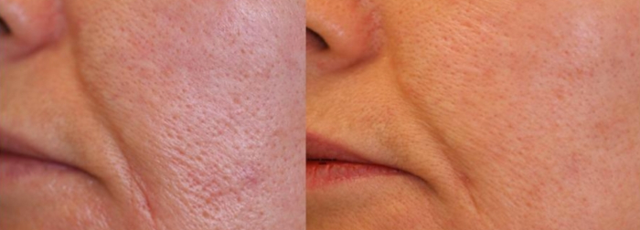 Pores laser treatment
