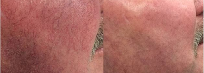 Spiders laser treatment