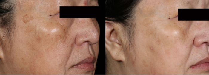Benign pigmentation spots laser treatment