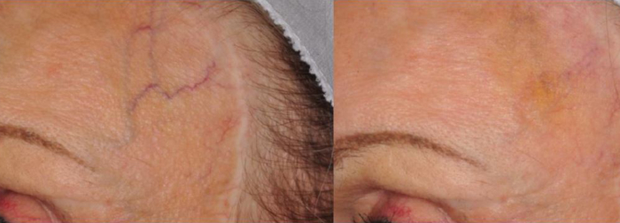 Veins forehead laser treatment
