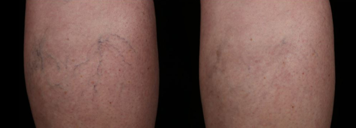 Traitement au laser des veines des jambes